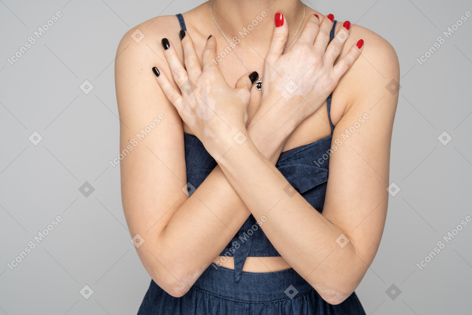 Female with vitiligo disease crossing hands on her chest