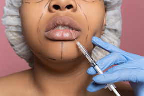 African-american woman undergoing lip augmentation procedure