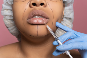 Mujer afroamericana sometida a un procedimiento de aumento de labios