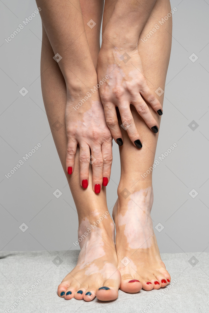 색소 침착이있는 여성 팔과 다리