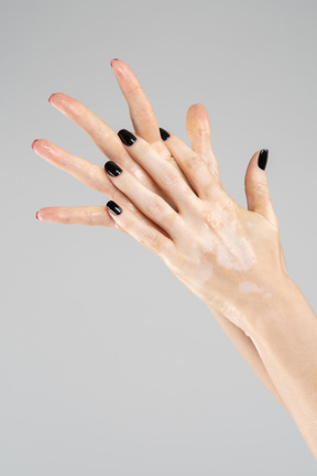 Female hands with pigmentation