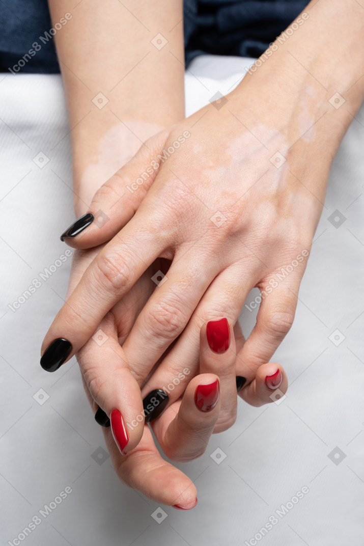 Female hands with pigmentation