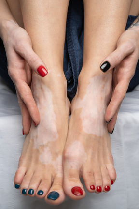 Holding feet with pigmentation together